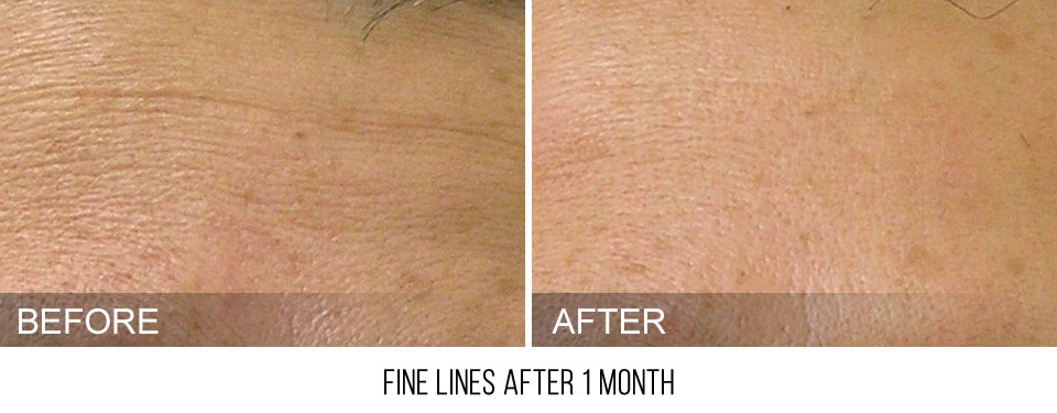 Hydrafacial before and after fine lines forehead