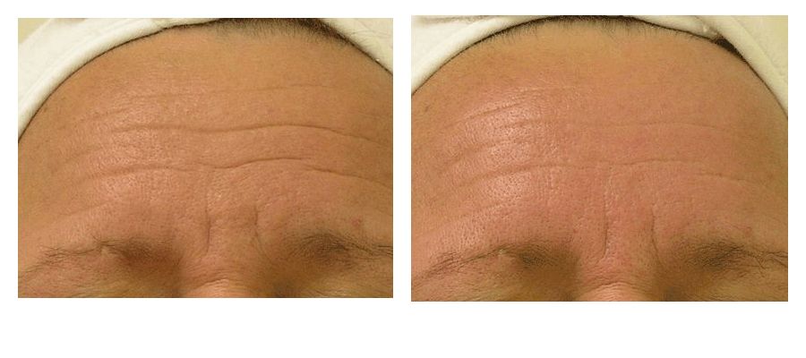 Hydrafacial before and after wrinkles Forehead