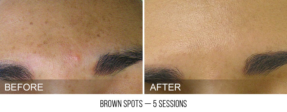 Hydrafacial before and after brown spots pigmentation