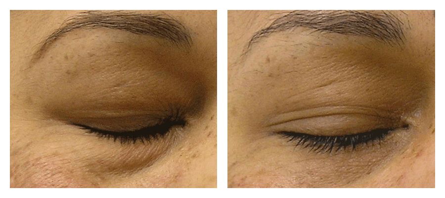 Hydrafacial before and after eye puffiness