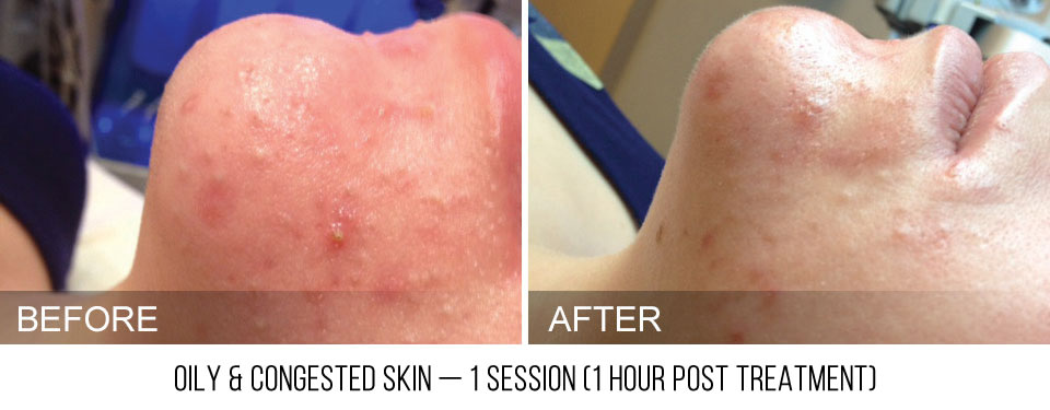 Hydrafacial before and after acne prone skin